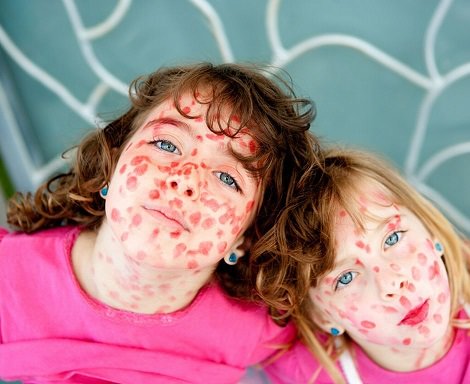 Спалах кору в Україні: що треба знати про хворобу